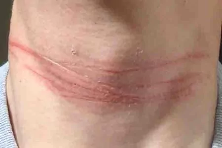 Neck lacerations from unknown string across road